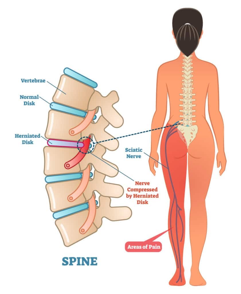 Quelles sont les causes d'une sciatique ? - Sciatic Pain Relief ...