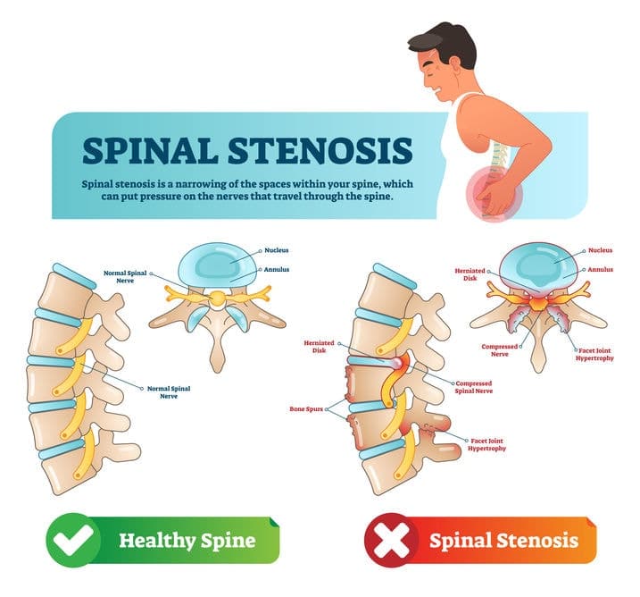  Spinal Stenosis Pillow