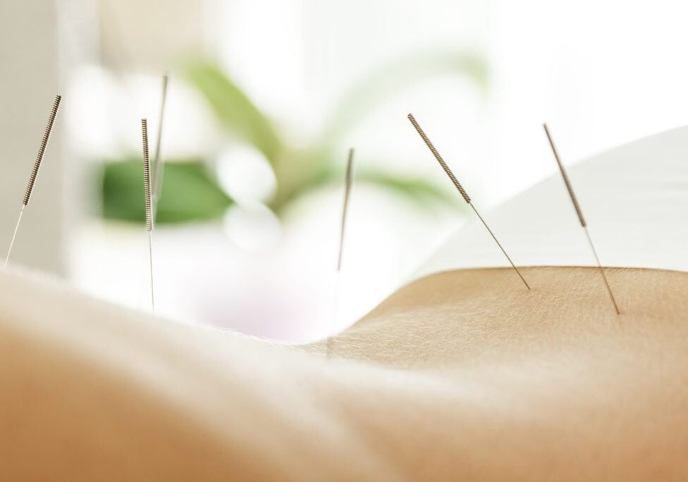 Acupuncture for sciatic nerve pain