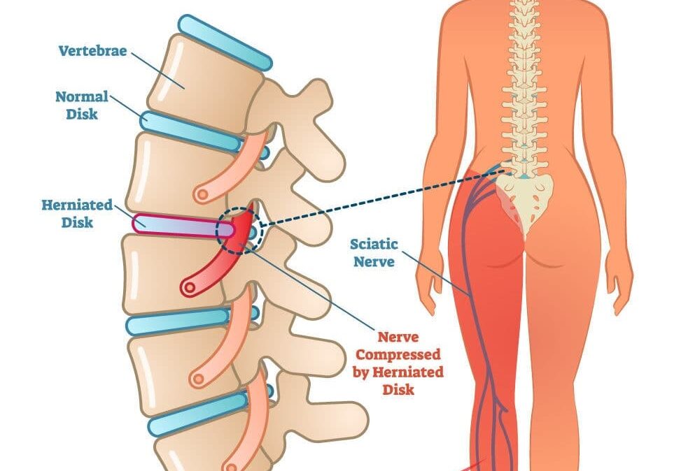 What is sciatica and what are the causes